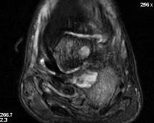 Diabetic Heel Abscess MRI 2